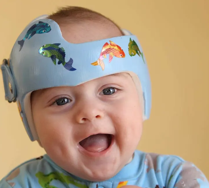 Image of a baby wearing a cranial molding helmet